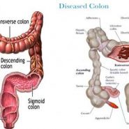 Colon Cleanse: The Healthy Way to Detox