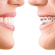Dental Care Tips for Those Who Wear Braces